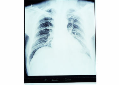 Good price Drukarka termiczna sucha folia na klatkę piersiową X Ray do AGFA 14 cali x 17 cali w Internecie