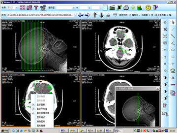 8 x 10 cali Medyczny laserowy obraz laserowy do diagnostyki rentgenowskiej dla KND-DRYTEC 4000