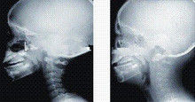 Good price Wysokie pokrycie atramentem, obrazowanie diagnostyczne promieniami rentgenowskimi, laserowy film rentgenowski o wymiarach 35 x 43 cm w Internecie