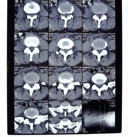 Przezroczystość Cyfrowa folia rentgenowska, obrazowanie medyczne AGFA / Fuji X Ray Dry Film
