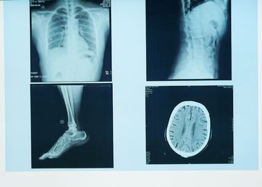 Trwałe obrazowanie diagnostyczne rentgenowskie, 32 cm x 43 cm medyczna papierowa laserowa niebieska folia rentgenowska