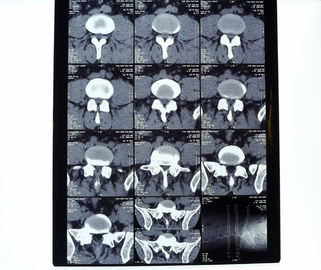 8-calowa * 10-calowa 14-calowa * 17-calowa sucha termiczna folia do drukarek rentgenowskich
