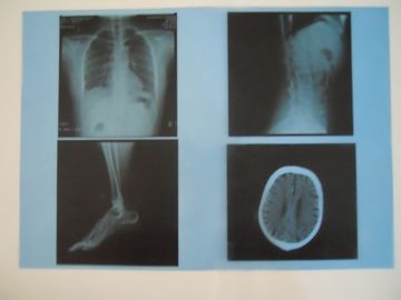 Good price Niska mgła KND-A Medical Dry Imaging Film do badania rentgenowskiego na AGFA 5300/5302/5500 w Internecie